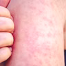 RFK tells American parents to vaccinate against measles