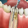 Root Canal: Save Your Smile