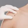 What is your experience with skin cancer?