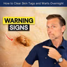How to Clear Skin Tags and Warts Overnight