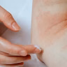 Psoriasis - your questions answered