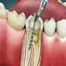 Root Canal: Save Your Smile