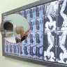 Dấu hiệu nhận biết sớm cong vẹo cột sống ở trẻ