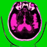Good news about Alzheimer’s