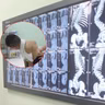 Dấu hiệu nhận biết sớm cong vẹo cột sống ở trẻ